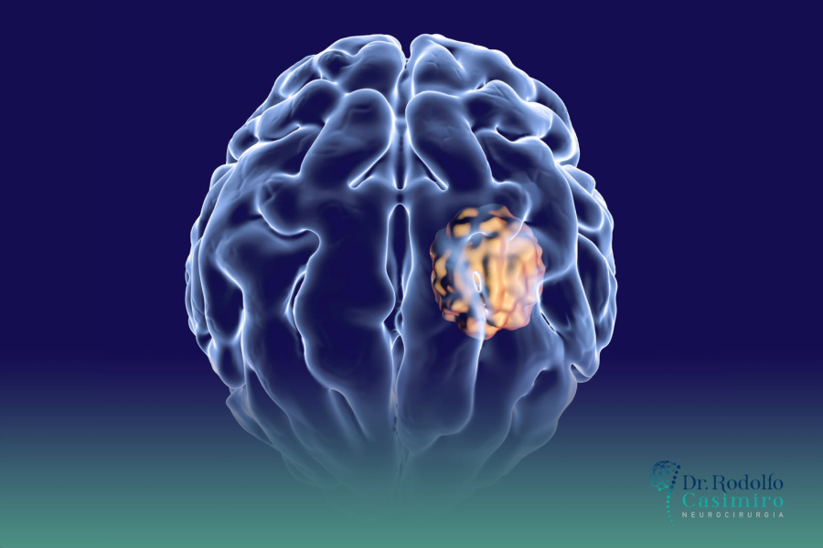 Neurocirurgia Oncológica: Muito Além da Cirurgia
